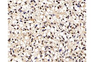 Immunohistochemistry analysis of paraffin-embedded human liver cancer using p27 Polyclonal Antibody at dilution of 1:200. (P27 antibody)