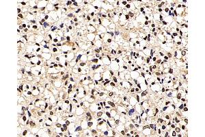 Immunohistochemistry analysis of paraffin-embedded human liver cancer using p27 Polyclonal Antibody at dilution of 1:200.