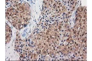 Immunohistochemical staining of paraffin-embedded Adenocarcinoma of Human breast tissue using anti-DSTN mouse monoclonal antibody. (Destrin antibody)