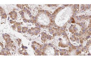 ABIN6279259 at 1/100 staining Human liver cancer tissue by IHC-P. (CEACAM20 antibody  (Internal Region))