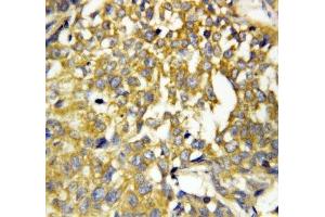 IHC-P: Pleiotrophin antibody testing of human breast cancer tissue (Pleiotrophin antibody  (C-Term))