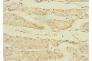 Immunohistochemistry of paraffin-embedded human gastric cancer using ABIN7144765 at dilution of 1:100 (ASTL antibody  (AA 38-337))