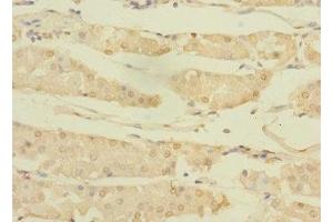 Immunohistochemistry of paraffin-embedded human gastric cancer using ABIN7144765 at dilution of 1:100 (ASTL antibody  (AA 38-337))