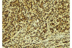 ABIN6269320 at 1/100 staining Human breast cancer tissue by IHC-P.