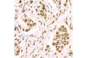 Immunohistochemistry of paraffin-embedded human breast cancer using HMGB1 Antibody. (HMGB1 antibody  (AA 100-200))