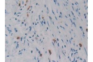 Detection of REG3g in Human Pancreatic cancer Tissue using Polyclonal Antibody to Regenerating Islet Derived Protein 3 Gamma (REG3g)