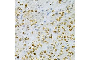 Immunohistochemistry of paraffin-embedded human liver cancer using DKC1 Antibody (ABIN5970956) at dilution of 1/200 (40x lens). (DKC1 antibody)