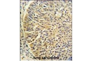 Formalin-fixed and paraffin-embedded human lung carcinoma reacted with CCT3 Antibody (Center), which was peroxidase-conjugated to the secondary antibody, followed by DAB staining.