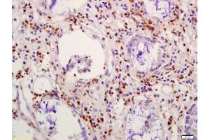 Formalin-fixed and paraffin embedded human colon carcinoma labeled with Anti-NFAT4 Polyclonal Antibody, Unconjugated (ABIN872596) at 1:200 followed by conjugation to the secondary antibody and DAB staining (CIDEC antibody  (AA 101-200))