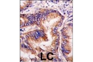 Formalin-fixed and paraffin-embedded human lung carcinoma tissue reacted with EIF2AK1 antibody (Center), which was peroxidase-conjugated to the secondary antibody, followed by DAB staining. (EIF2AK1 antibody  (AA 267-296))