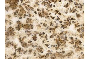 ABIN6257280 and ABIN6273765 at 1/100 staining human melanoma by IHC-P.