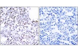 Immunohistochemistry analysis of paraffin-embedded human breast carcinoma tissue, using SMC1 (Ab-957) Antibody. (SMC1A antibody  (AA 931-980))