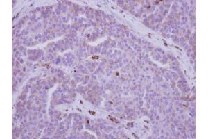 IHC-P Image Immunohistochemical analysis of paraffin-embedded human adenocarcinoma, using MYH9, antibody at 1:500 dilution. (Myosin 9 antibody  (N-Term))