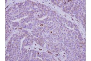 IHC-P Image Immunohistochemical analysis of paraffin-embedded human adenocarcinoma, using MYH9, antibody at 1:500 dilution.