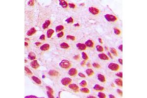 Immunohistochemical analysis of HOXC6 staining in human prostate cancer formalin fixed paraffin embedded tissue section. (Homeobox C6 antibody  (C-Term))