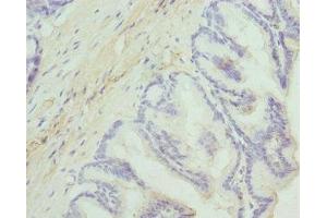 Immunohistochemistry of paraffin-embedded human prostate cancer using ABIN7149844 at dilution of 1:100 (DGKA antibody  (AA 1-200))