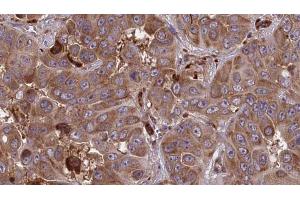 ABIN6273858 at 1/100 staining Human liver cancer tissue by IHC-P.
