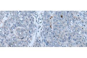 Immunohistochemistry of paraffin-embedded Human liver cancer tissue using NF1 Polyclonal Antibody at dilution of 1:65(x200) (Neurofibromin 1 antibody)