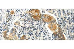 Immunohistochemistry of paraffin-embedded Human cervical cancer using MSI1 Polyclonal Antibody at dilution of 1/30 (MSI1 antibody)