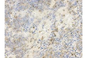 ABIN6256507 and ABIN6267633 at 1/100 staining human melanoma by IHC-P. (PAK1 antibody  (pThr212))