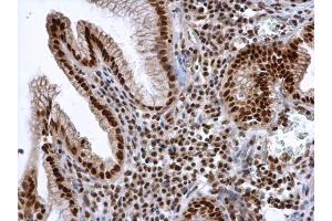 IHC-P Image ALY antibody detects ALY protein at nucleus in human esophageal cancer by immunohistochemical analysis. (THO Complex 4 antibody)