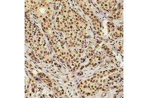 Immunohistochemical analysis of XRCC4 staining in human breast cancer formalin fixed paraffin embedded tissue section. (XRCC4 antibody)