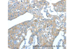 Immunohistochemistry of Human breast cancer using AMPH Polyclonal Antibody at dilution of 1:25 (Amphiphysin antibody)