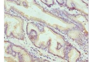 Immunohistochemistry of paraffin-embedded human prostate cancer using ABIN7157199 at dilution of 1:100 (Kallikrein 1 antibody  (AA 35-276))