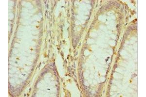 Immunohistochemistry of paraffin-embedded human colon cancer using ABIN7155133 at dilution of 1:100 (HNRNPM antibody  (AA 491-730))