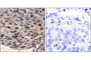 Immunohistochemistry analysis of paraffin-embedded human breast carcinoma, using 4E-BP1 (Phospho-Thr36) Antibody. (eIF4EBP1 antibody  (pThr37))