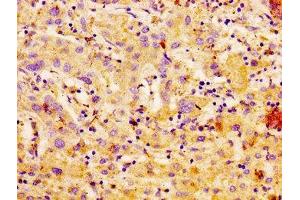 IHC image of ABIN7146723 diluted at 1:100 and staining in paraffin-embedded human liver cancer performed on a Leica BondTM system. (CA4 antibody  (AA 75-200))