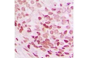 Immunohistochemical analysis of NEIL3 staining in human breast cancer formalin fixed paraffin embedded tissue section. (NEIL3 antibody  (C-Term))