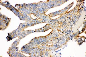 Anti- gamma Catenin Picoband antibody, IHC(P) IHC(P): Human Intestinal Cancer Tissue (JUP antibody  (AA 556-745))