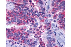 Anti-GPR137B antibody IHC of human Ovary, Carcinoma. (GPR137B antibody  (Cytoplasmic Domain))