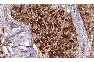 ABIN6272677 at 1/100 staining Human liver cancer tissue by IHC-P. (Calcitonin Receptor antibody  (N-Term))