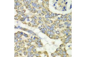 Immunohistochemistry of paraffin-embedded human esophageal cancer using TUFM antibody.