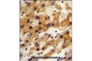 GAGE13 Antibody (N-term) (ABIN654525 and ABIN2844247) immunohistochemistry analysis in formalin fixed and paraffin embedded human hepatocarcinoma followed by peroxidase conjugation of the secondary antibody and DAB staining. (G Antigen 13 antibody  (N-Term))