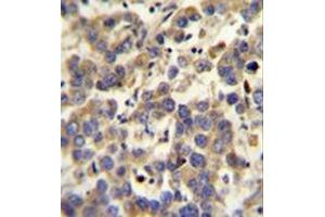 Immunohistochemistry analysis in formalin fixed and paraffin embedded human testis carcinoma reacted with  LYPD4 Antibody (Center) followed which was peroxidase conjugated to the secondary antibody and followed by DAB staining. (LYPD4 antibody  (Middle Region))