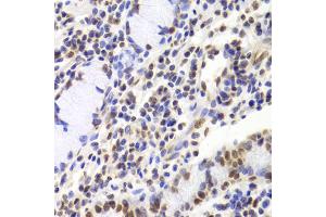 Immunohistochemistry of paraffin-embedded human gastric cancer using XRCC5 Antibody. (XRCC5 antibody)
