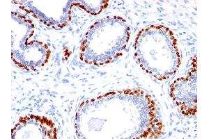 Formalin-fixed, paraffin-embedded human Prostate Carcinoma stained with p40 Rabbit Polyclonal Antibody. (p63 antibody  (AA 5-17))