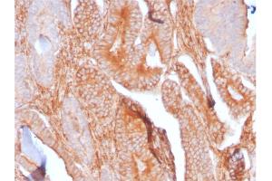 Formalin-fixed, paraffin-embedded human Prostate Carcinoma stained with CD81 Rabbit Recombinant Monoclonal Antibody (C81/2885R).