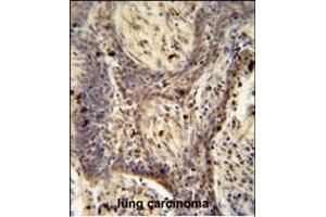 RC1 antibody (C-term) (ABIN654964 and ABIN2844603) immunohistochemistry analysis in formalin fixed and paraffin embedded human lung carcinoma followed by peroxidase conjugation of the secondary antibody and DAB staining. (PPRC1 antibody  (C-Term))