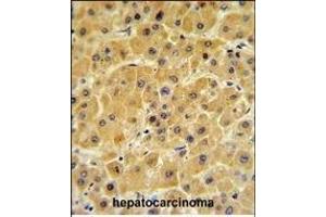 F10 Antibody (C-term) (ABIN390688 and ABIN2840978) IHC analysis in formalin fixed and paraffin embedded human hepatocarcinoma followed by peroxidase conjugation of the secondary antibody and DAB staining. (Coagulation Factor X antibody  (C-Term))