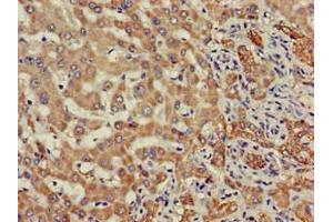 Immunohistochemistry of paraffin-embedded human liver cancer using ABIN7171195 at dilution of 1:100