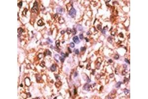 IHC analysis of FFPE human hepatocarcinoma tissue stained with the phospho-Rb antibody. (Retinoblastoma Protein (Rb) antibody  (pSer788))