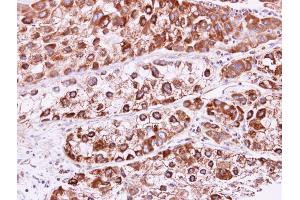 IHC-P Image RAB2B antibody detects RAB2B protein at cytoplasm and membrane on human liver carcinoma by immunohistochemical analysis. (RAB2B antibody)
