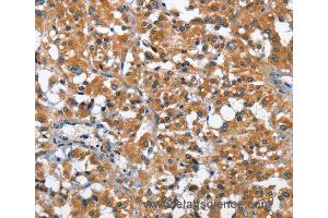 Immunohistochemistry of Human thyroid cancer using ARMCX2 Polyclonal Antibody at dilution of 1:40