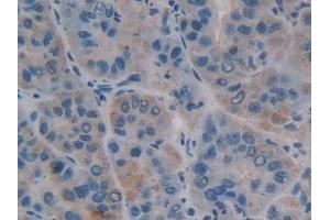 Detection of CA125 in Human Liver cancer Tissue using Polyclonal Antibody to Carbohydrate Antigen 125 (CA125)