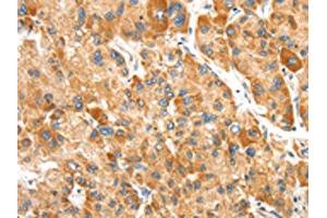 The image on the left is immunohistochemistry of paraffin-embedded Human liver cancer tissue using ABIN7192438(SLC24A6 Antibody) at dilution 1/20, on the right is treated with synthetic peptide. (SLC24A6 antibody)