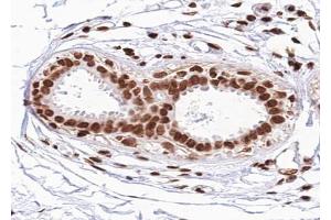 ABIN6267625 at 1/100 staining human Breast carcinoma tissue sections by IHC-P. (FOXO1 antibody  (pSer329))
